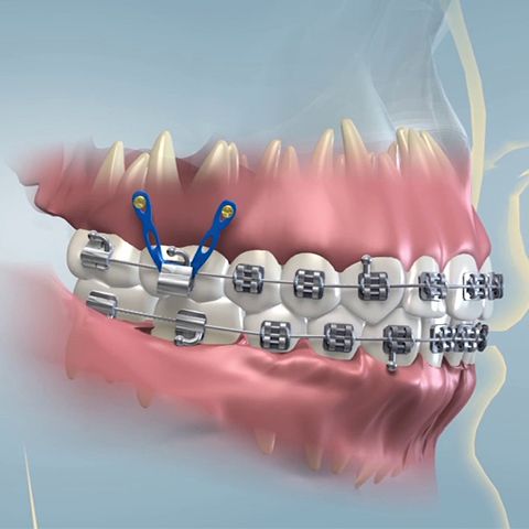 Traditional Orthodontics