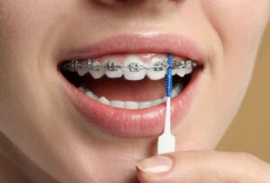 Close-up of person using interdental brush to clean around her braces