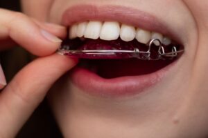 Close-up of woman placing a retainer in her mouth